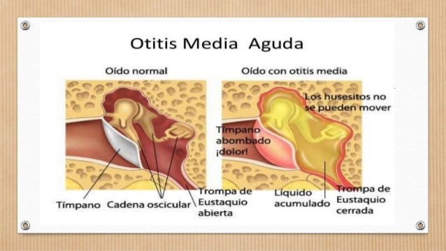 Otitis media aguda otitis media aguda