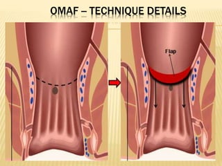 OMAF -- TECHNIQUE DETAILS
 