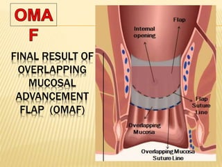 FINAL RESULT OF
OVERLAPPING
MUCOSAL
ADVANCEMENT
FLAP (OMAF)
 