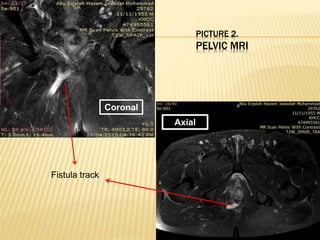 PICTURE 2.
PELVIC MRI
Coronal
Axial
Fistula track
 