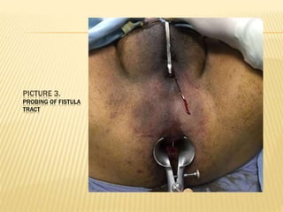 PICTURE 3.
PROBING OF FISTULA
TRACT
 