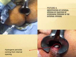 PICTURE 4.
IDENTIFICATION OF INTERNAL
OPENING BY INJECTION OF
HYDROGENE PEROXIDE IN THE
EXTERNAL OPENING
Hydrogene peroxide
coming from internal
opening
 