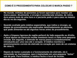 • No mundo, milhões de pacientes já foram operados para receber um
marca passo. Atualmente, a cirurgia é considerada simples, de rotina,
dura pouco mais de uma hora e o paciente pode ir para casa no mesmo
dia ou no dia seguinte.
• Quando avaliado pelo médico especialista, que indica a cirurgia, as
etapas do procedimento são explicadas detalhadamente ao paciente,
que pode alimentar-se até algumas horas antes do procedimento.
• Após a limpeza rigorosa da região peitoral do lado esquerdo ou direito,
o local abaixo da clavícula recebe anestesia local e é feita uma pequena
incisão. Em seguida, o eletrodo do marca passo é cuidadosamente
introduzido por uma veia até o coração. O médico monitora o
posicionamento correto do eletrodo no coração por meio de um sistema
de raios X.
• Depois de testar a posição e o funcionamento do eletrodo, ele é
conectado ao marcapasso, que é implantado em uma pequena “bolsa”
sob da pele. Para finalizar, o médico fecha o local da incisão.
COMO É O PROCEDIMENTO PARA COLOCAR O MARCA PASSO ?
 