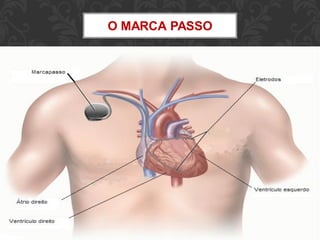 O MARCA PASSO
 