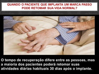 O tempo de recuperação difere entre as pessoas, mas
a maioria dos pacientes poderá retomar suas
atividades diárias habituais 30 dias após o implante.
QUANDO O PACIENTE QUE IMPLANTA UM MARCA PASSO
PODE RETOMAR SUA VIDA NORMAL?
 