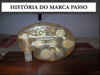 História do marca passo no
Brasil
HISTÓRIA DO MARCA PASSO
 