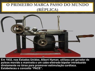O PRIMEIRO MARCA PASSO DO MUNDO
(RÉPLICA)
Em 1932, nos Estados Unidos, Albert Hyman, utilizou um gerador de
pulsos movido a manivela e um cabo-eletrodo bipolar introduzido
diretamente no tórax para promover estimulação cardíaca.
Estabeleceu o conceito “PACE”.
 