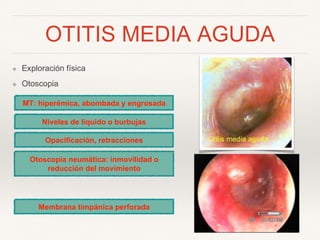 OTITIS MEDIA AGUDA
❖ Exploración física
❖ Otoscopia
Otoscopia neumática: inmovilidad o
reducción del movimiento
MT: hiperémica, abombada y engrosada
Niveles de líquido o burbujas
Opacificación, retracciones
Membrana timpánica perforada
 
