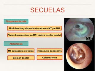 SECUELAS
Timpanoesclerosis
Hialinización y depósito de calcio en MT y/u OM
Placas blanquecinas en MT, cadena oscilar inmóvil
Atelectasias
MT colapsada o retraída Hipoacusia conductiva
Erosión oscilar Colesteatoma
 