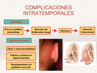 COMPLICACIONES
INTRATEMPORALES
Mastoiditis
Pus en celdillas
mastoideas
Necrosis de
trabéculas óseas
Absceso
Mastoiditis aguda
Dolor e hipersensibilidad
Edema y eritema en
tejidos blandos
Desplazamiento de
pabellón auricular
Infección
intracraneal
 