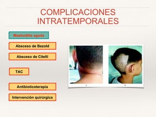 COMPLICACIONES
INTRATEMPORALES
Mastoiditis aguda
Absceso de Bezold
Absceso de Citelli
TAC
Antibioticoterapia
Intervención quirúrgica
 