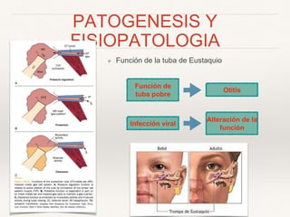 PATOGENESIS Y
FISIOPATOLOGIA
❖ Función de la tuba de Eustaquio
Función de
tuba pobre
Otitis
Infección viral
Alteración de la
función
 