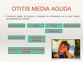 OTITIS MEDIA AGUDA
❖ Comienzo rápido de signos y sintomas de inflamación en el oído medio
acompañado por efusión
Otalgia Fiebre
Hipoacusia
Perforación
timpánica
Lactantes -> irritabilidad, tiran del oído
afectado
Fase de colección Malestar general
Fase de otorrea
 