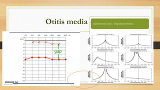 Otitis media crónica
• Diagnóstico
Audiometría tonal / Impedanciometría
 