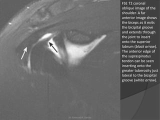 FSE T2 coronal
oblique image of the
shoulder. A far
anterior image shows
the biceps as it exits
the bicipital groove
and extends through
the joint to insert
onto the superior
labrum (black arrow).
The anterior edge of
the supraspinatus
tendon can be seen
inserting onto the
greater tuberosity just
lateral to the bicipital
groove (white arrow).
Dr. Emanuel R. Dantas
 