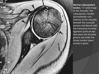 Normal subscapularis
tendon. T2* axial image
of the shoulder. The
subscapularis tendon
(arrowheads) runs
anterior to the shoulder
beneath the coracoid
process and blends with
the transverse humeral
ligament (solid arrow)
that spans the bicipital
groove and holds the
biceps tendon (open
arrow) in place.
Dr. Emanuel R. Dantas
 