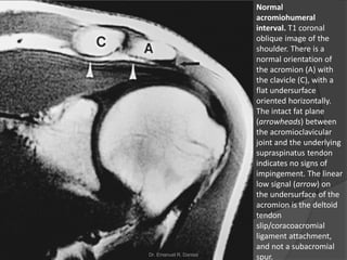 Normal
acromiohumeral
interval. T1 coronal
oblique image of the
shoulder. There is a
normal orientation of
the acromion (A) with
the clavicle (C), with a
flat undersurface
oriented horizontally.
The intact fat plane
(arrowheads) between
the acromioclavicular
joint and the underlying
supraspinatus tendon
indicates no signs of
impingement. The linear
low signal (arrow) on
the undersurface of the
acromion is the deltoid
tendon
slip/coracoacromial
ligament attachment,
and not a subacromial
spur.
Dr. Emanuel R. Dantas
 