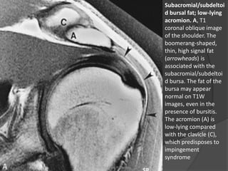 Subacromial/subdeltoi
d bursal fat; low-lying
acromion. A, T1
coronal oblique image
of the shoulder. The
boomerang-shaped,
thin, high signal fat
(arrowheads) is
associated with the
subacromial/subdeltoi
d bursa. The fat of the
bursa may appear
normal on T1W
images, even in the
presence of bursitis.
The acromion (A) is
low-lying compared
with the clavicle (C),
which predisposes to
impingement
syndrome
Dr. Emanuel R. Dantas
 