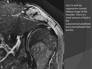 Fast T2 with fat
suppression coronal
oblique image of the
shoulder. There is a
small amount of fluid in
the
subacromial/subdeltoid
bursa (arrowhead) from
bursitis.
Dr. Emanuel R. Dantas
 
