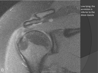 Low-lying; the
acromion is
inferior to the
distal clavicle
Dr. Emanuel R. Dantas
 