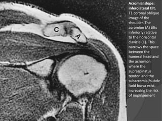 Acromial slope:
inferolateral tilt.
T1 coronal oblique
image of the
shoulder. The
acromion (A) tilts
inferiorly relative
to the horizontal
clavicle (C). This
narrows the space
between the
humeral head and
the acromion
where the
supraspinatus
tendon and the
subacromial/subde
ltoid bursa exist,
increasing the risk
of impingement
Dr. Emanuel R. Dantas
 
