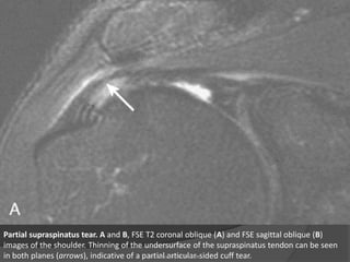 Partial supraspinatus tear. A and B, FSE T2 coronal oblique (A) and FSE sagittal oblique (B)
images of the shoulder. Thinning of the undersurface of the supraspinatus tendon can be seen
in both planes (arrows), indicative of a partial articular-sided cuff tear.
Dr. Emanuel R. Dantas
 