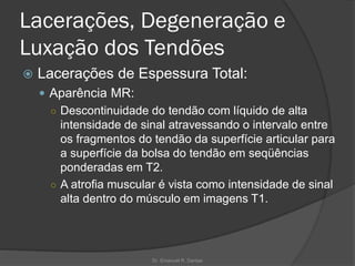 Lacerações, Degeneração e
Luxação dos Tendões
 Lacerações de Espessura Total:
 Aparência MR:
○ Descontinuidade do tendão com líquido de alta
intensidade de sinal atravessando o intervalo entre
os fragmentos do tendão da superfície articular para
a superfície da bolsa do tendão em seqüências
ponderadas em T2.
○ A atrofia muscular é vista como intensidade de sinal
alta dentro do músculo em imagens T1.
Dr. Emanuel R. Dantas
 