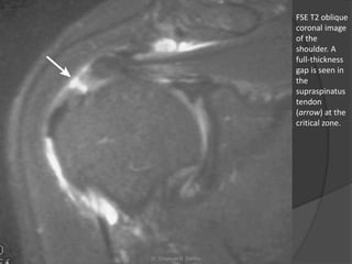 FSE T2 oblique
coronal image
of the
shoulder. A
full-thickness
gap is seen in
the
supraspinatus
tendon
(arrow) at the
critical zone.
Dr. Emanuel R. Dantas
 