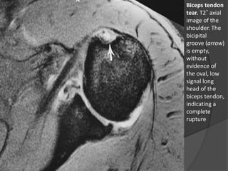 Biceps tendon
tear. T2* axial
image of the
shoulder. The
bicipital
groove (arrow)
is empty,
without
evidence of
the oval, low
signal long
head of the
biceps tendon,
indicating a
complete
rupture
Dr. Emanuel R. Dantas
 