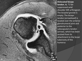 Dislocated biceps
tendon. A, T1 fat-
suppressed axial
shoulder MR arthrogram.
The bicipital groove is
empty. The biceps
tendon (arrowhead) is
located over the anterior
glenohumeral joint and
posterior to the
subscapularis tendon
(arrow), which has been
avulsed from its
attachment to the lesser
tuberosity of the
humerus
Dr. Emanuel R. Dantas
 