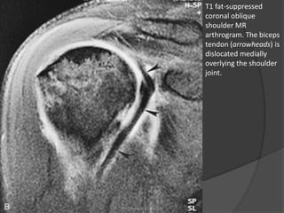 T1 fat-suppressed
coronal oblique
shoulder MR
arthrogram. The biceps
tendon (arrowheads) is
dislocated medially
overlying the shoulder
joint.
Dr. Emanuel R. Dantas
 