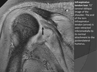 Infraspinatus
tendon tear. T2*
coronal oblique
image of the
shoulder. The end
of the torn
infraspinatus
tendon (arrow) is
seen retracted
inferomedially to
its normal
attachment to the
posterolateral
humerus.
Dr. Emanuel R. Dantas
 