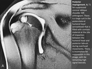 Posterior
impingement. A, T1
fat-suppressed
coronal oblique
shoulder MR
arthrogram. There
is a large cyst in the
posterolateral
humeral head
(arrowhead) that is
filled with contrast
material at the site
of impaction
between the
humeral head and
posterior labrum
during overhead
movements. There
is incomplete fat
suppression in this
image, with fat
remaining high
signal laterally
Dr. Emanuel R. Dantas
 