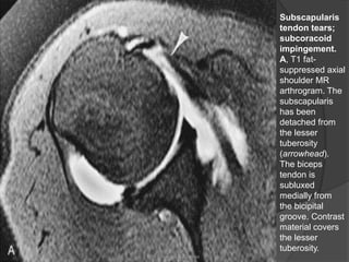 Subscapularis
tendon tears;
subcoracoid
impingement.
A, T1 fat-
suppressed axial
shoulder MR
arthrogram. The
subscapularis
has been
detached from
the lesser
tuberosity
(arrowhead).
The biceps
tendon is
subluxed
medially from
the bicipital
groove. Contrast
material covers
the lesser
tuberosity.
Dr. Emanuel R. Dantas
 