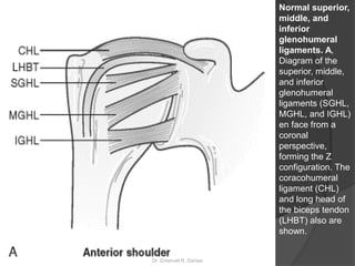 Normal superior,
middle, and
inferior
glenohumeral
ligaments. A,
Diagram of the
superior, middle,
and inferior
glenohumeral
ligaments (SGHL,
MGHL, and IGHL)
en face from a
coronal
perspective,
forming the Z
configuration. The
coracohumeral
ligament (CHL)
and long head of
the biceps tendon
(LHBT) also are
shown.
Dr. Emanuel R. Dantas
 