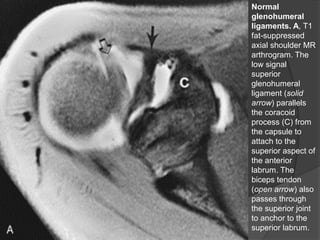 Normal
glenohumeral
ligaments. A, T1
fat-suppressed
axial shoulder MR
arthrogram. The
low signal
superior
glenohumeral
ligament (solid
arrow) parallels
the coracoid
process (C) from
the capsule to
attach to the
superior aspect of
the anterior
labrum. The
biceps tendon
(open arrow) also
passes through
the superior joint
to anchor to the
superior labrum.
Dr. Emanuel R. Dantas
 
