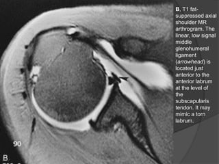 B, T1 fat-
suppressed axial
shoulder MR
arthrogram. The
linear, low signal
middle
glenohumeral
ligament
(arrowhead) is
located just
anterior to the
anterior labrum
at the level of
the
subscapularis
tendon. It may
mimic a torn
labrum.
Dr. Emanuel R. Dantas
 
