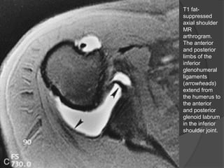 T1 fat-
suppressed
axial shoulder
MR
arthrogram.
The anterior
and posterior
limbs of the
inferior
glenohumeral
ligaments
(arrowheads)
extend from
the humerus to
the anterior
and posterior
glenoid labrum
in the inferior
shoulder joint.
Dr. Emanuel R. Dantas
 