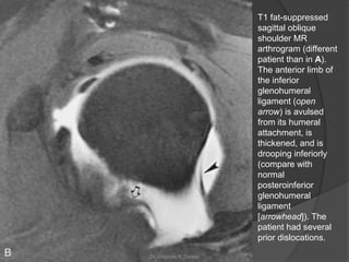 T1 fat-suppressed
sagittal oblique
shoulder MR
arthrogram (different
patient than in A).
The anterior limb of
the inferior
glenohumeral
ligament (open
arrow) is avulsed
from its humeral
attachment, is
thickened, and is
drooping inferiorly
(compare with
normal
posteroinferior
glenohumeral
ligament
[arrowhead]). The
patient had several
prior dislocations.
Dr. Emanuel R. Dantas
 