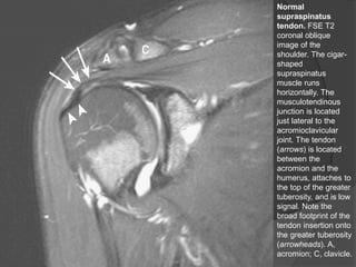 Normal
supraspinatus
tendon. FSE T2
coronal oblique
image of the
shoulder. The cigar-
shaped
supraspinatus
muscle runs
horizontally. The
musculotendinous
junction is located
just lateral to the
acromioclavicular
joint. The tendon
(arrows) is located
between the
acromion and the
humerus, attaches to
the top of the greater
tuberosity, and is low
signal. Note the
broad footprint of the
tendon insertion onto
the greater tuberosity
(arrowheads). A,
acromion; C, clavicle.
Dr. Emanuel R. Dantas
 