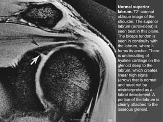 Normal superior
labrum. T2* coronal
oblique image of the
shoulder. The superior
labrum (arrowhead) is
seen best in this plane.
The biceps tendon is
seen in continuity with
the labrum, where it
forms its anchor. There
is undercutting of
hyaline cartilage on the
glenoid deep to the
labrum, which creates
linear high signal
(arrow) that is normal
and must not be
misinterpreted as a
labral detachment. A
portion of the labrum is
clearly attached to the
osseous glenoid.
Dr. Emanuel R. Dantas
 