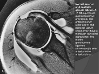 Normal anterior
and posterior
glenoid labrum. A,
T1 fat-suppressed
axial shoulder MR
arthrogram. The
anterior labrum
(solid arrow) and
posterior labrum
(open arrow) have a
triangular, low signal
appearance. The
middle
glenohumeral
ligament
(arrowhead) is seen
anterior to the
anterior labrum.
Dr. Emanuel R. Dantas
 