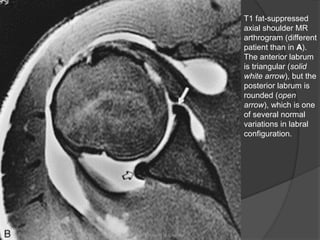 T1 fat-suppressed
axial shoulder MR
arthrogram (different
patient than in A).
The anterior labrum
is triangular (solid
white arrow), but the
posterior labrum is
rounded (open
arrow), which is one
of several normal
variations in labral
configuration.
Dr. Emanuel R. Dantas
 