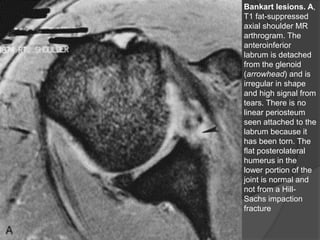 Bankart lesions. A,
T1 fat-suppressed
axial shoulder MR
arthrogram. The
anteroinferior
labrum is detached
from the glenoid
(arrowhead) and is
irregular in shape
and high signal from
tears. There is no
linear periosteum
seen attached to the
labrum because it
has been torn. The
flat posterolateral
humerus in the
lower portion of the
joint is normal and
not from a Hill-
Sachs impaction
fracture
Dr. Emanuel R. Dantas
 