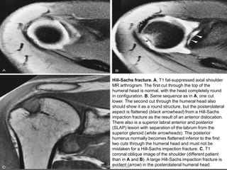 Hill-Sachs fracture. A, T1 fat-suppressed axial shoulder
MR arthrogram. The first cut through the top of the
humeral head is normal, with the head completely round
in configuration. B, Same sequence as in A, one cut
lower. The second cut through the humeral head also
should show it as a round structure, but the posterolateral
aspect is flattened (black arrowhead) from a Hill-Sachs
impaction fracture as the result of an anterior dislocation.
There also is a superior labral anterior and posterior
(SLAP) lesion with separation of the labrum from the
superior glenoid (white arrowheads). The posterior
humerus normally becomes flattened inferior to the first
two cuts through the humeral head and must not be
mistaken for a Hill-Sachs impaction fracture. C, T1
coronal oblique image of the shoulder (different patient
than in A and B). A large Hill-Sachs impaction fracture is
evident (arrow) in the posterolateral humeral head.
Dr. Emanuel R. Dantas
 