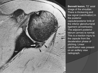 Bennett lesion. T2* axial
image of the shoulder.
There is thickening and
low signal (calcification) in
the posterior
capsule/posterior limb of
the inferior glenohumeral
ligament (arrowheads).
The adjacent posterior
labrum (arrow) is normal.
This is a traction injury to
the capsule from the
deceleration phase of
pitching. Linear
calcification was present
on an axillary view
radiograph.
Dr. Emanuel R. Dantas
 
