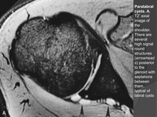 Paralabral
cysts. A,
T2* axial
image of
the
shoulder.
There are
several
high signal
round
structures
(arrowhead
s) posterior
to the
glenoid with
septations
between
them,
typical of
labral cysts
Dr. Emanuel R. Dantas
 