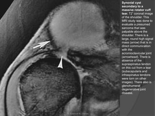 Synovial cyst
secondary to a
massive rotator cuff
tear. T2* coronal image
of the shoulder. This
MRI study was done to
evaluate a presumed
sarcoma that was
palpable above the
shoulder. There is a
large, round high signal
mass (arrow) that is in
direct communication
with the
acromioclavicular joint
(arrowhead). There is
absence of the
supraspinatus tendon
on this cut from a tear
(subscapularis and
infraspinatus tendons
were torn on other
images). There also is
glenohumeral
degenerative joint
disease.
Dr. Emanuel R. Dantas
 