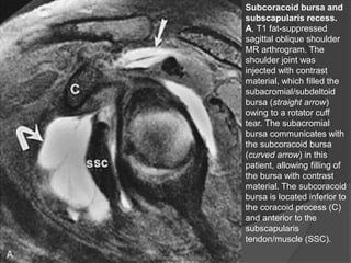 Subcoracoid bursa and
subscapularis recess.
A, T1 fat-suppressed
sagittal oblique shoulder
MR arthrogram. The
shoulder joint was
injected with contrast
material, which filled the
subacromial/subdeltoid
bursa (straight arrow)
owing to a rotator cuff
tear. The subacromial
bursa communicates with
the subcoracoid bursa
(curved arrow) in this
patient, allowing filling of
the bursa with contrast
material. The subcoracoid
bursa is located inferior to
the coracoid process (C)
and anterior to the
subscapularis
tendon/muscle (SSC).
Dr. Emanuel R. Dantas
 