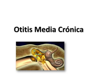 Otitis Media Crónica
 